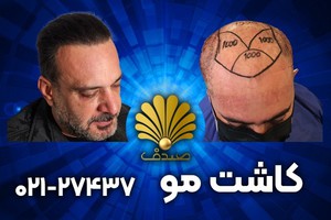 جدیدترین روش کاشت مو به وسیله ایمپلنتر تنها در یک جلسه | تضمینی