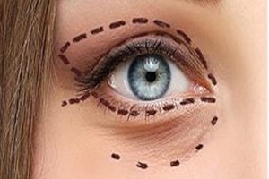 رفع افتادگی پلک با لیزر برای اولین بار در ایران توسط جراح چشم